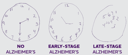 The sketches you here were drawn by individuals who were administered the Clock Drawing Test, a common cognitive screening test used to help aid in Alzheimer's diagnosis as well as determine how far the disease has progressed.