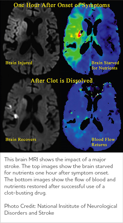 Vascular Dementia Symptoms And Treatments