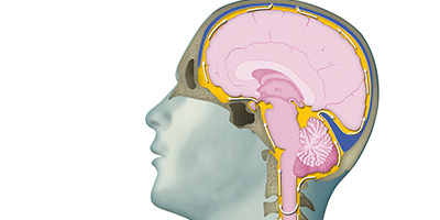 Image of a brain affected by normal pressure hydrocephalus