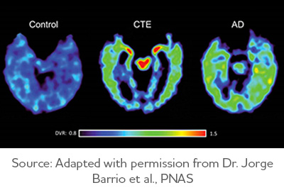 Scan showing control brain, brain with CTE, and brain with Alzheimer's