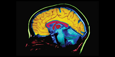 El Alzheimer y la demencia son enfermedades y no son una parte normal del envejecimiento.