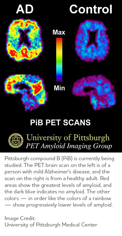 A brain scan that shows amyloid plaques in the brain of a person with Alzheimer's and a control brain without amyloid plaques. Photo from University of Pittsburgh Medical Center
